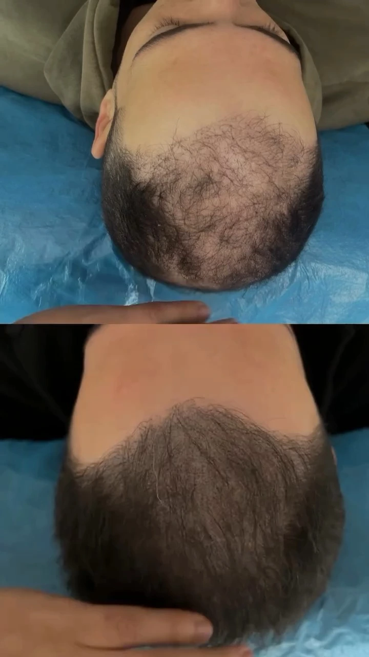 Ön bölgedeki seyrek görünümün işlem öncesi ve bir ay sonraki ikinci seans sonundaki iki fotoğrafı
