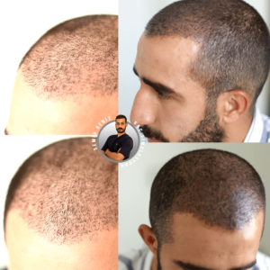 saç simulasyonu öncesi ve sonrası