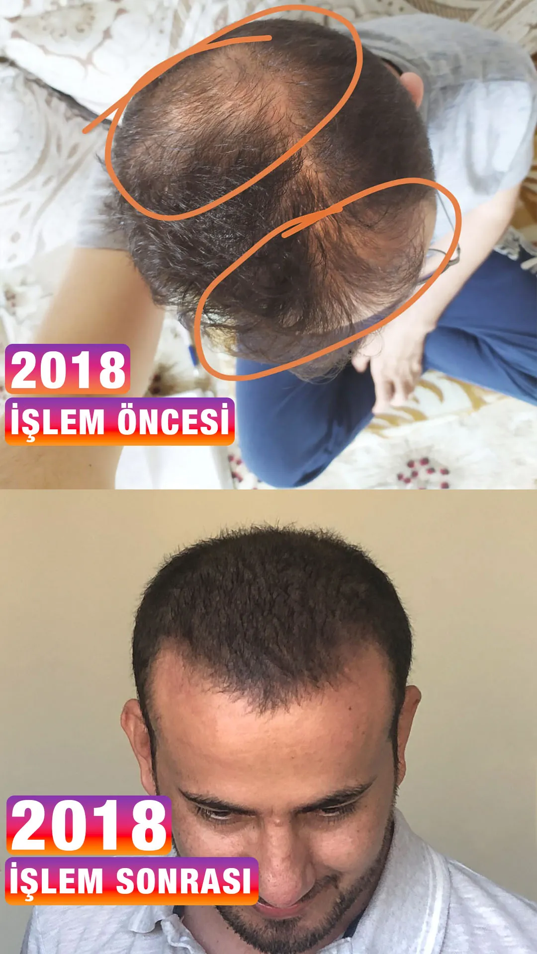 Mardin’den gelen danışanın ilk saç simülasyonu uygulaması öncesi (üstte, turuncu işaretli seyrek bölgeler) ve sonrası (altta) görünümü