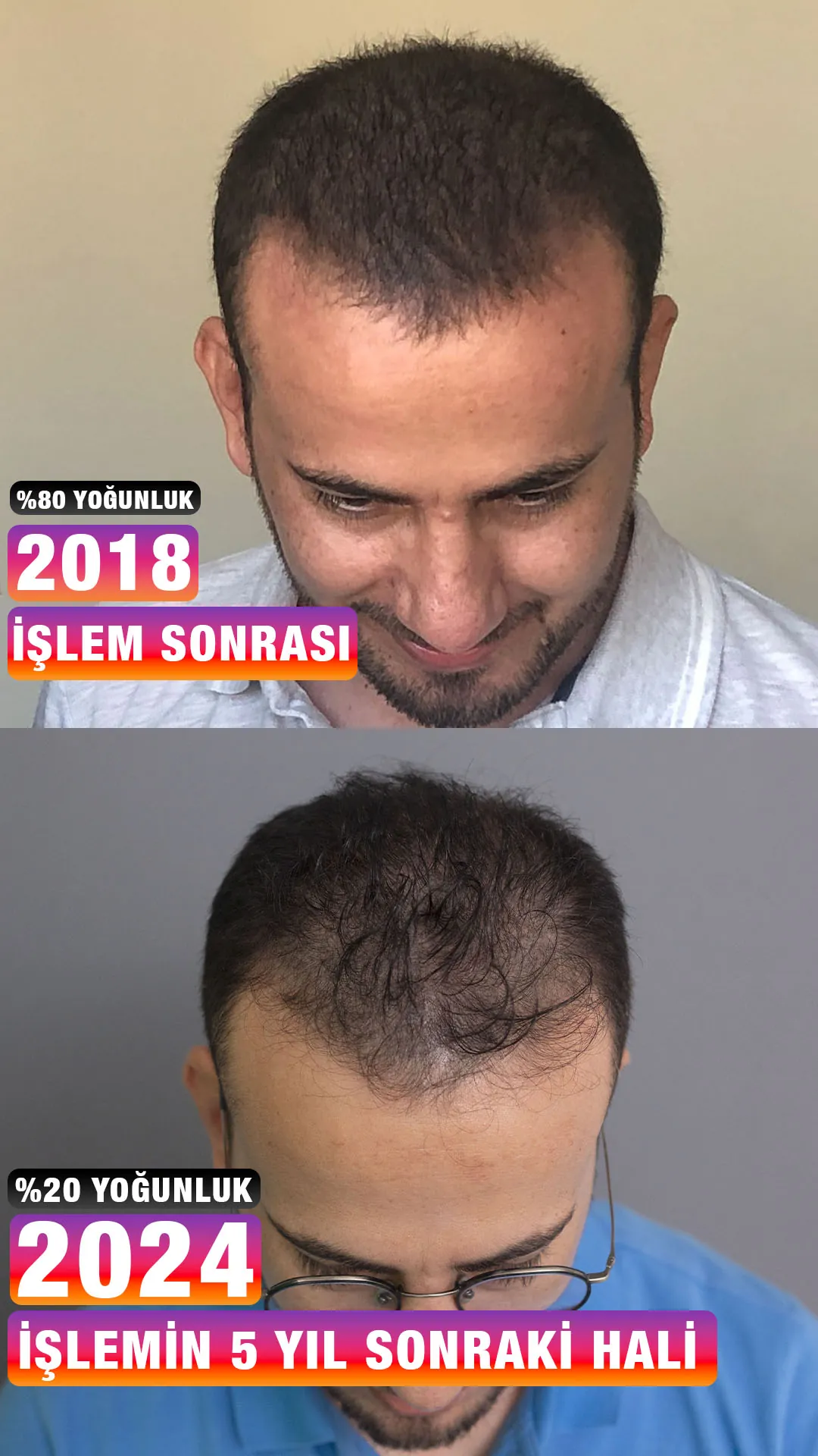 Mardinli danışanın saç simülasyonu ilk uygulama sonrası görünümü (üstte) ile işlemden yaklaşık 5 yıl sonraki hali (altta)