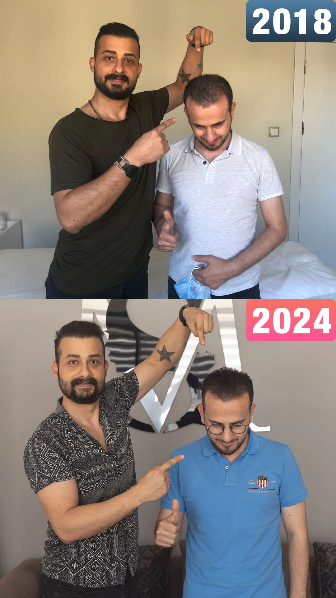 Mardinli danışan ve Uzm. Est. Semih Deniz’in ilk saç simülasyonu uygulaması (üstte) ile rötuş sonrası (altta) hatıra fotoğrafları