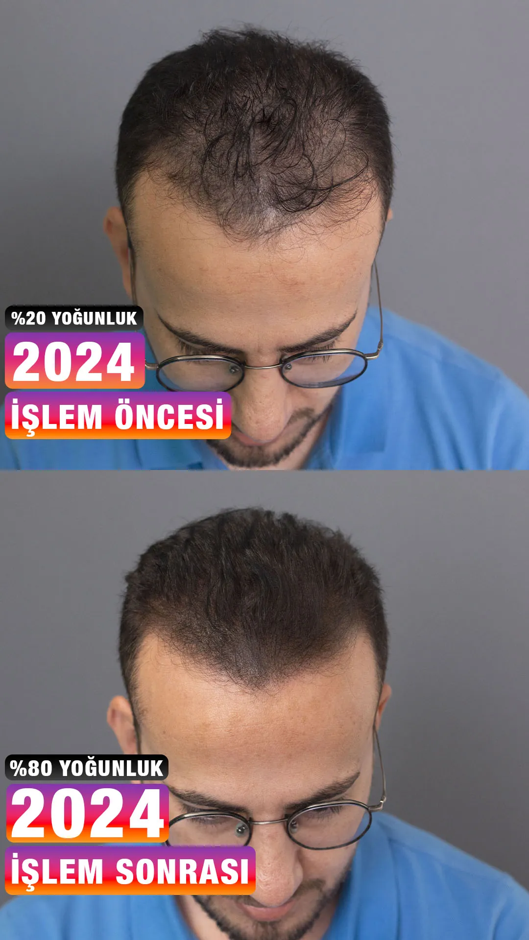 Mardinli danışanın beş yıl sonra rötuş öncesi ve sonrası üstten karşılaştırması