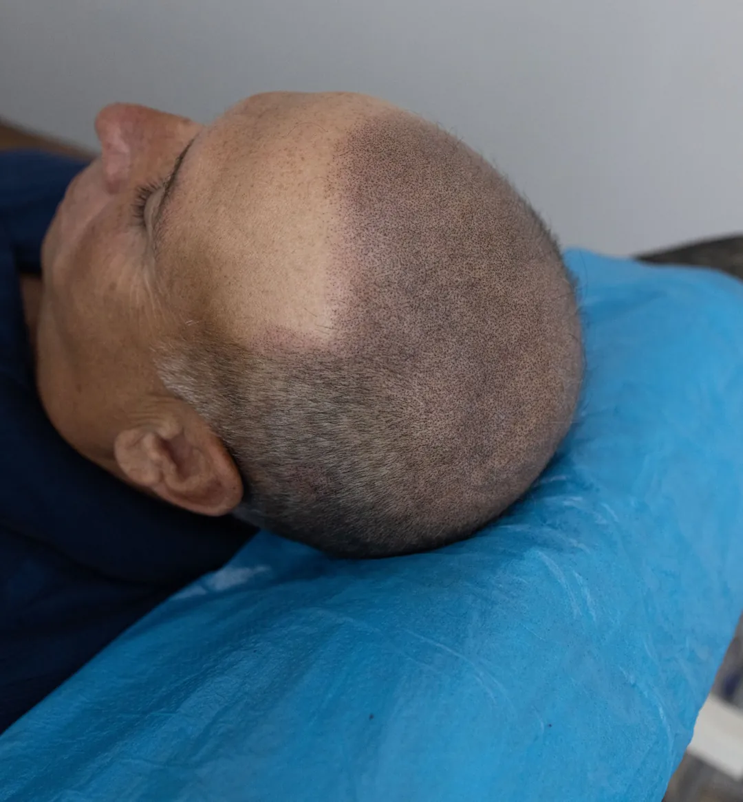 Muşlu danışanın saç simülasyonu sonrası uygulama masasında yatarken yandan görünümü; üst bölge ve ön hat pigmentle kapatılmış