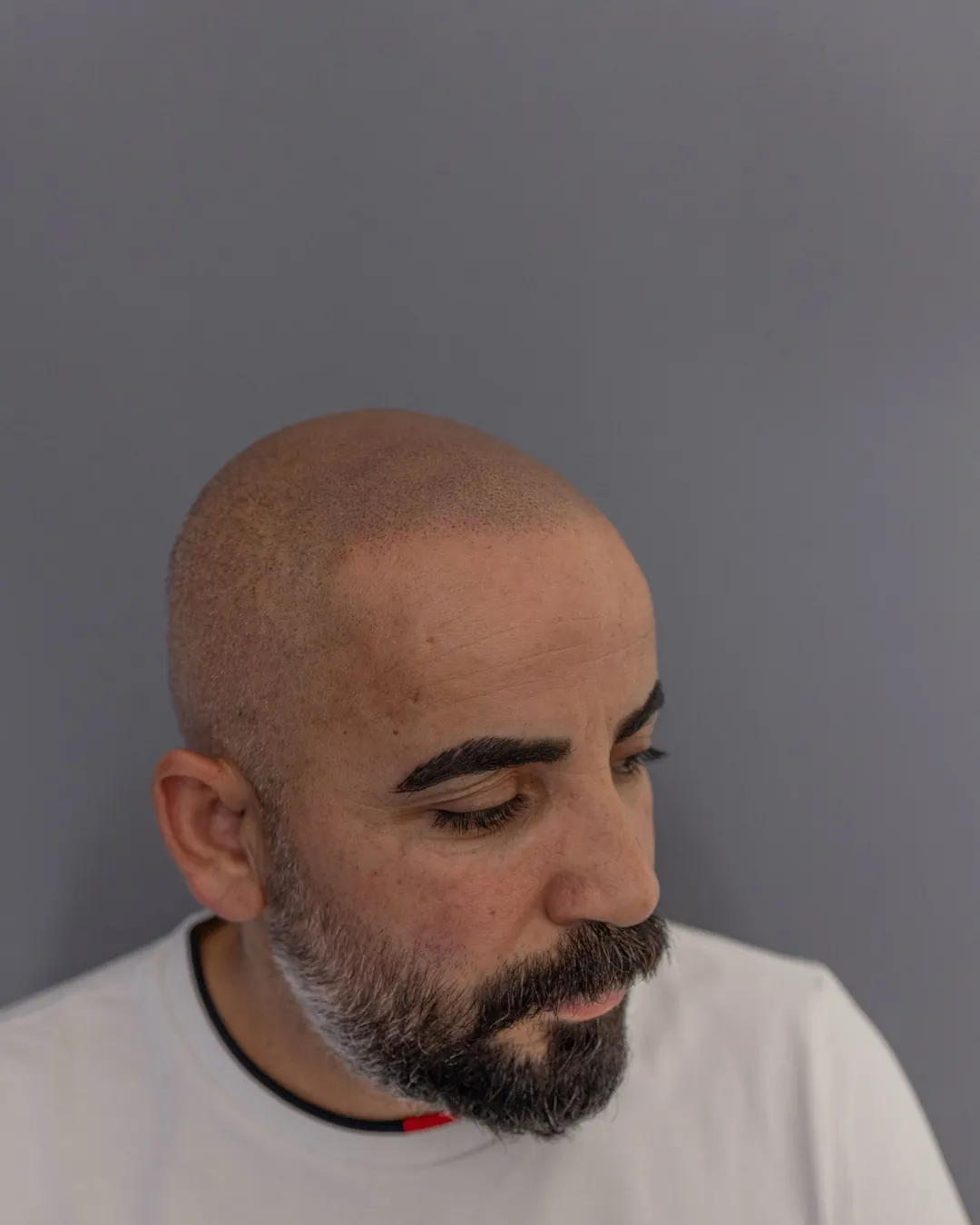 Siirt saç simülasyonu yenileme sonrası şakak ve yan bölge yakın çekim